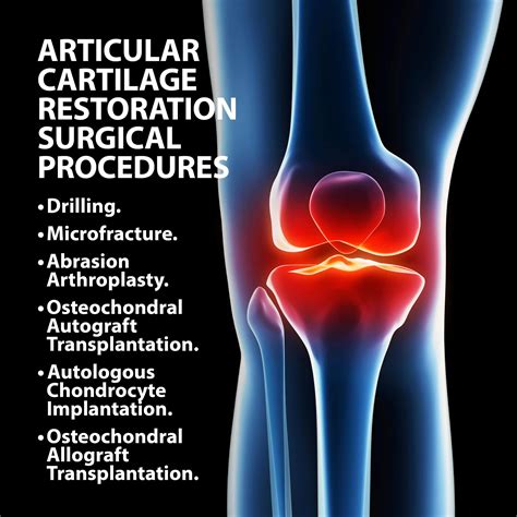 Articular Cartilage Restoration Florida Orthopaedic Institute
