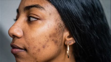 Targeted Treatments For Black Skin Acne100 Genuine