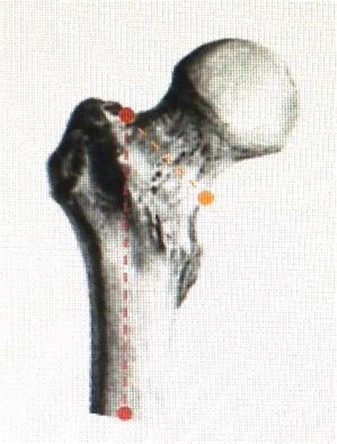 The 45 Rule From The Trochanteric Fossa Commonly Confound With