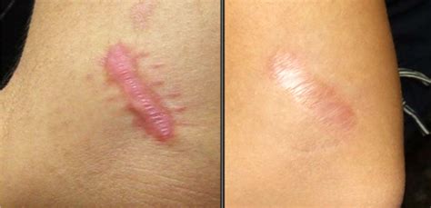 This can help in preventing keloids from growing on certain areas of skin. 10 Epic Natural Remedies to Remove Keloids