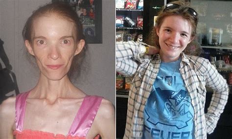 Anorexia Patient Who Weighs 58lbs Prepares For An Early Death Daily
