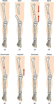 Another benefit of backbone is the ease of communicating with the server through ajax interactions. Bone fracture - Wikipedia