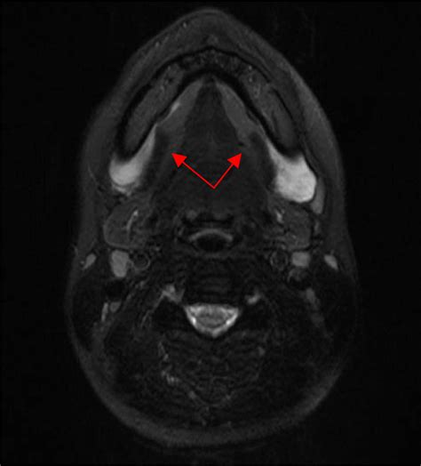 Plunging Ranula T2 Weighted Mri Showing Bilateral Plunging Ranulae