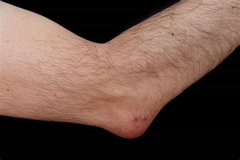 Bursitis Stock Photos Pictures And Royalty Free Images Istock