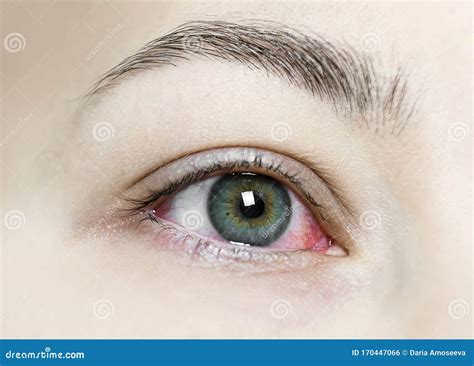Close Up Of A Severe Bloodshot Red Eye Viral Blepharitis