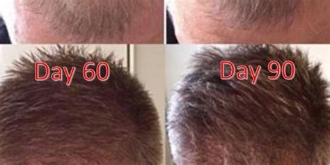 Platelet Rich Plasma Prp Prp For Hair Restoration Prp Before And After Prp Hair Loss Results