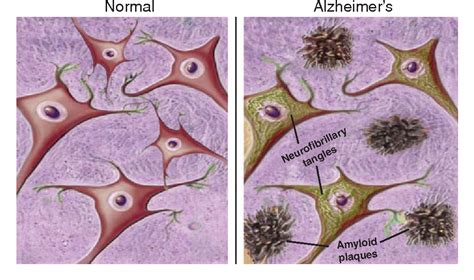 Figure 2 From Neurobiological Aspects Of Alzheimers Disease