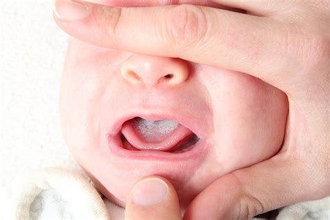 Fungal Infection In Babies Risks Treatment And Remedies