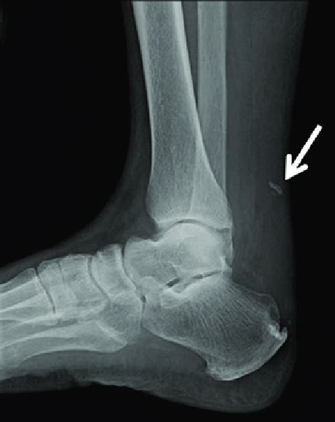 The achilles tendon, seen in this diagram, attaches to the back of the heel bone (calcaneus) about halfway between the top and bottom of the back of the heel bone. Calcaneal spur and calcification (arrow) were observed in ...