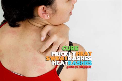 Sweat blisters caused by sunburn. 26 Natural Home Remedies for Prickly Heat, Sweat Rashes ...