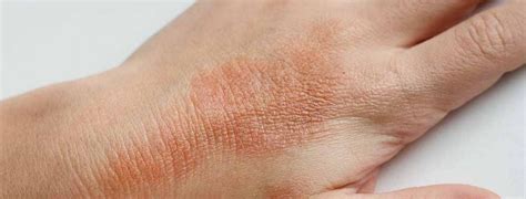 Dermatite Atopica Cause Cure E Rimedi Naturali