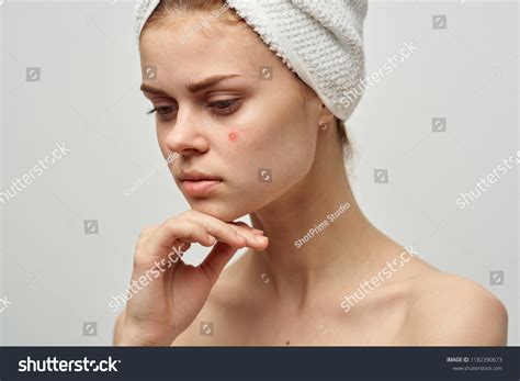 Pimples On Face Beautiful Woman Nude Stock Photo Shutterstock