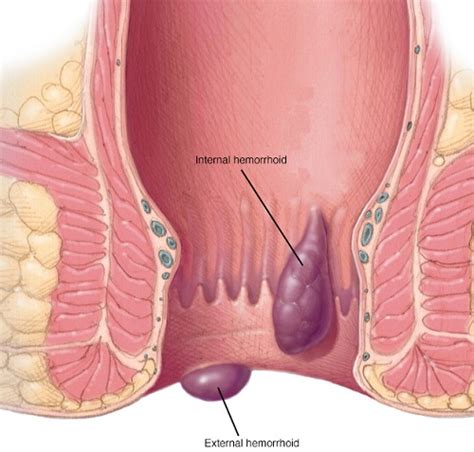 How To Use Essential Oils To Treat Hemorrhoids Md