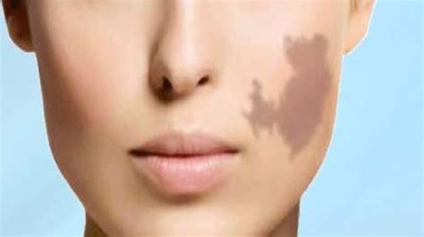 How To Get Rid Of Birthmarks On Your Face Naturally Youtube