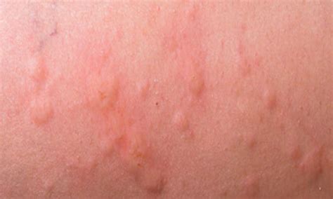 Viral Rashes In Adults Skin Hives Childhood Rash Common Child Disorders