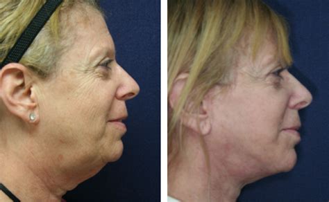 Double Chin Removal Surgical And Non Surgical Options