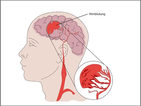 Abdominal swelling , völlegefühl oder blähungen. Weltschlaganfalltag: So entsteht ein Schlaganfall ...