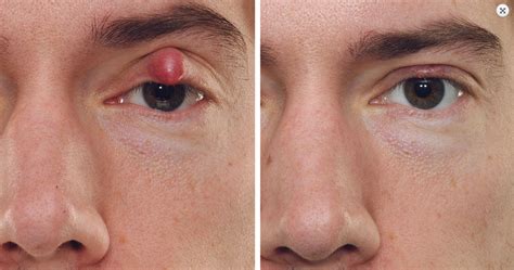 Before And After Eye Cysts Beforeandafter Cosmeticsurgery Laser