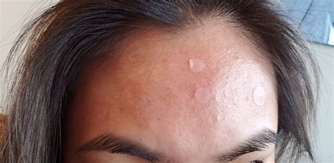 Forehead Bumps General Acne Discussion Forum