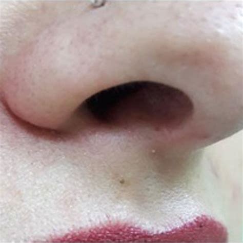 View Of A 31 Year Old Female Patient With Telangiectasia Under The Nose