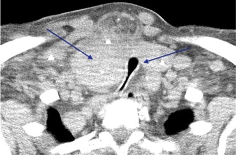 Cervical Lymphadenopathy Metastasis Of Papillary Carcinoma Or Ectopic