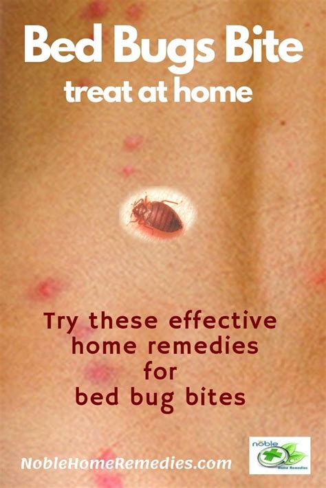 10 Effective Bed Bug Bites Home Remedies And Preventions Bug Bites