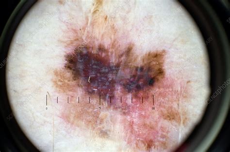 Malignant Melanoma Examination Stock Image C0401004 Science