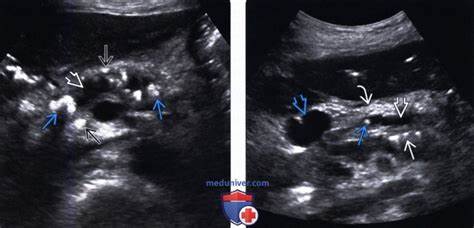 Как похудеть при хроническом пиелонефрите