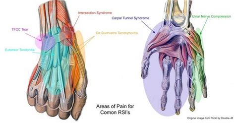 What Is Rsi And How To Treat It