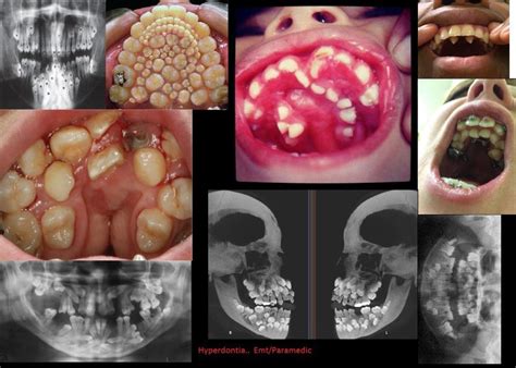 Check spelling or type a new query. Fake hyperdontia photo? Real hyperdontia picture?