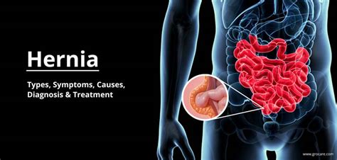 What Is Hernia Types Causes Diagnosis Prevention And Treatment