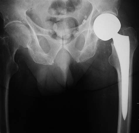 Joint Arthroplasty A Gallery
