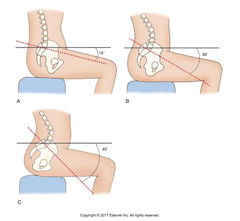 What Is Lower Crossed Syndrome And What Are Its Causes
