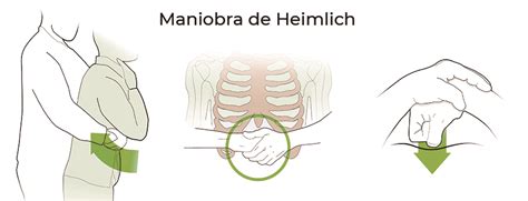 La Importancia De La Maniobra De Heimlich Gcardio