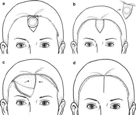 Forehead Plastic Surgery Key