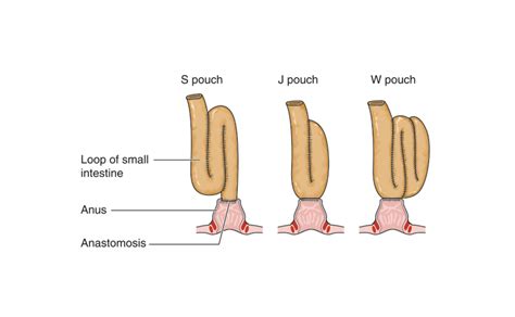 Maybe you would like to learn more about one of these? Things I wish I knew before having J-pouch surgery