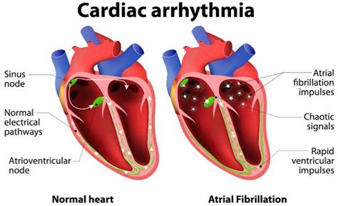 Heart Dysrhythmia Causes Signs Symptoms Diagnosis And Treatment