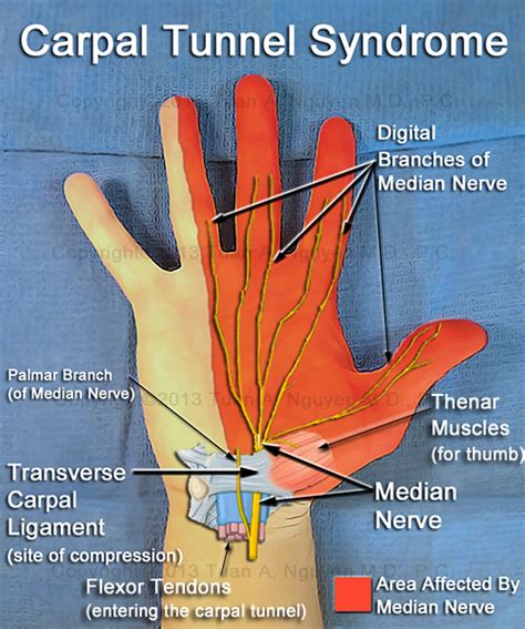 Signs And Symptoms Of Carpal Tunnel Syndrome Portland Hand Surgery