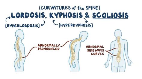Lordosis Kyphosis And Scoliosis Video And Anatomy Osmosis