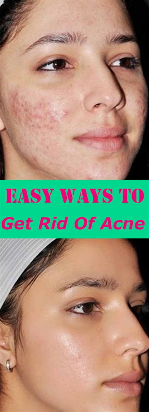 Pin On Acne Scars Fade