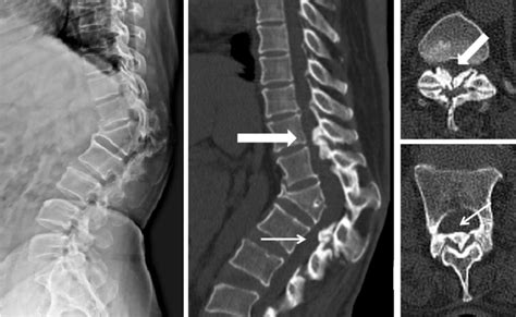 If severe, it can be associated with central canal stenosis. Ligamentum Flavum - Ossification Of The Ligamentum Flavum ...