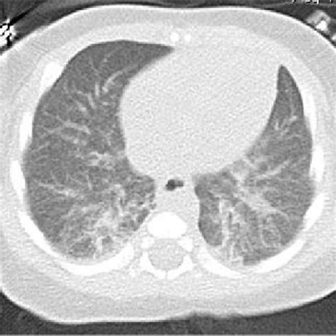 Chest Ct Demonstrated Bilateral Ground Glass Infiltrates Download