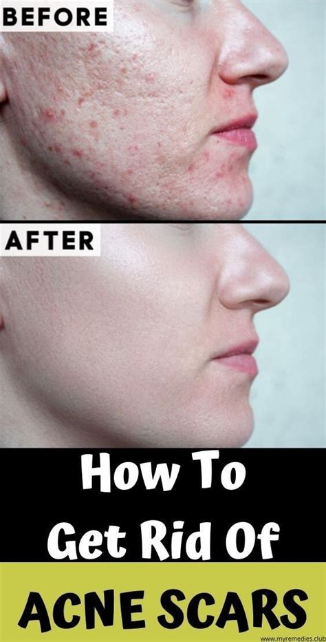 How To Heal Acne Scars Heal Info