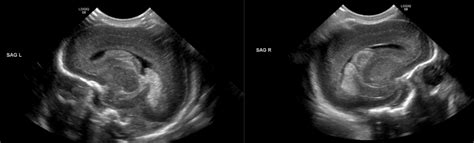 Intraventricular Hemorrhage Ultrasound