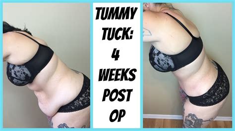 Tummy Tuck 4 Weeks Post Op Update Youtube