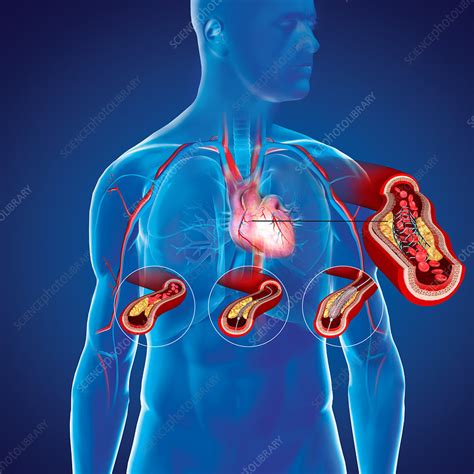 Angioplasty With Stent Placement Illustration Stock Image C046