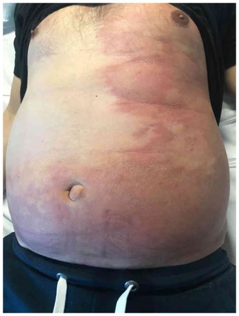 Skin Metastases From Gastric Cancer A Rare Entity Masquerading As