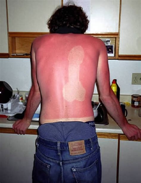 Of The Worst Tanning Fails You Ll See This Summer The Dreaded