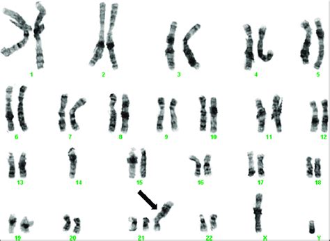 Chromosome Syndrome