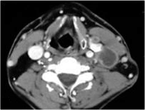 Lymph Node Central Necrosis On Computed Tomography As Predictor Of